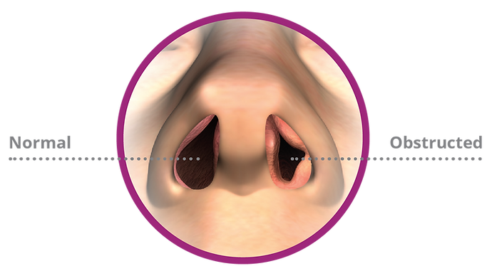 A vector diagram showing the difference between a normal and obstructed nostril.