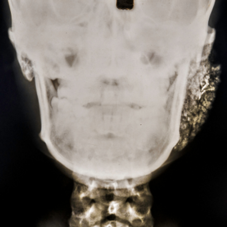 An x-ray of the neck area.