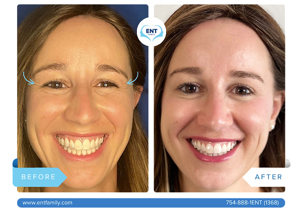 Botox for Crow's Feet