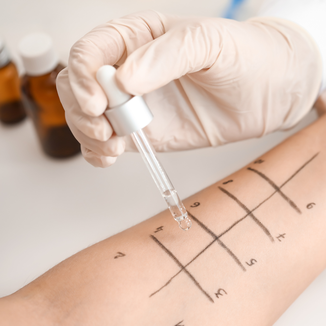 minimally invasive Allergy Testing on forearm