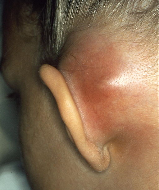 Subperiosteal abscess in mastoiditis