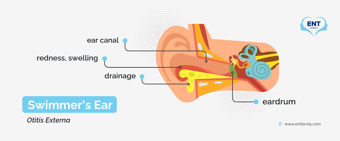 A vector illustration of a Swimmer's Ear by ENT Family.