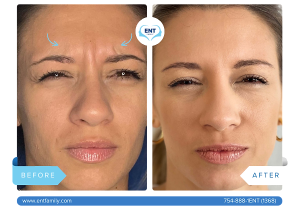 Botox for Glabella