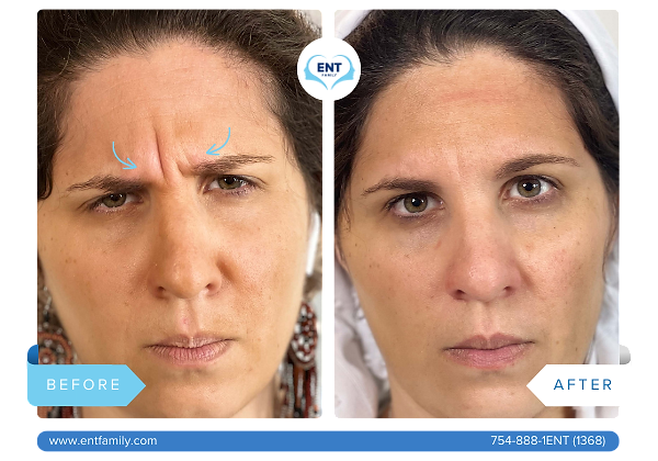 Botox for Glabella